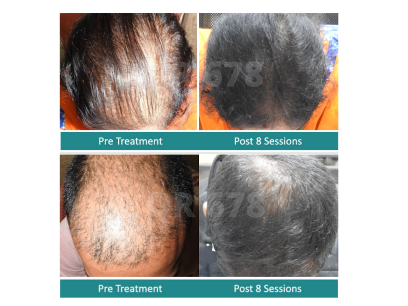 As they age women lose their hair too Which treatments really work